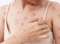 Dinas Kesehatan DKI Temukan Tujuh Kasus Cacar Monyet di Jakarta Selatan