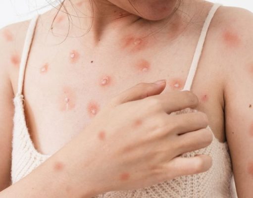 Dinas Kesehatan DKI Temukan Tujuh Kasus Cacar Monyet di Jakarta Selatan