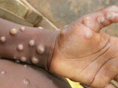 Sebanyak 24 Kasus Cacar Monyet Semua Laki-laki dengan Gejala Ringan