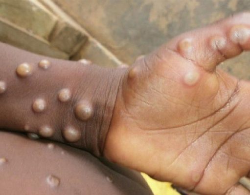 Sebanyak 24 Kasus Cacar Monyet Semua Laki-laki dengan Gejala Ringan