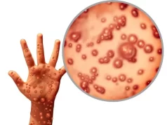 Kasus Cacar Monyet di Jakarta Menjadi 34 Orang Tertular Melalui Kontak Seksual