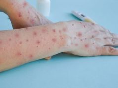 Dinas Kesehatan DKI: Kasus Monkeypox di Ibu Kota 42 Orang