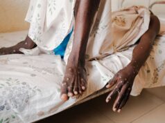 Kasus Mpox Baru ditemukan Diluar Wilayah Endemisnya, Dua dari Asia Tenggara